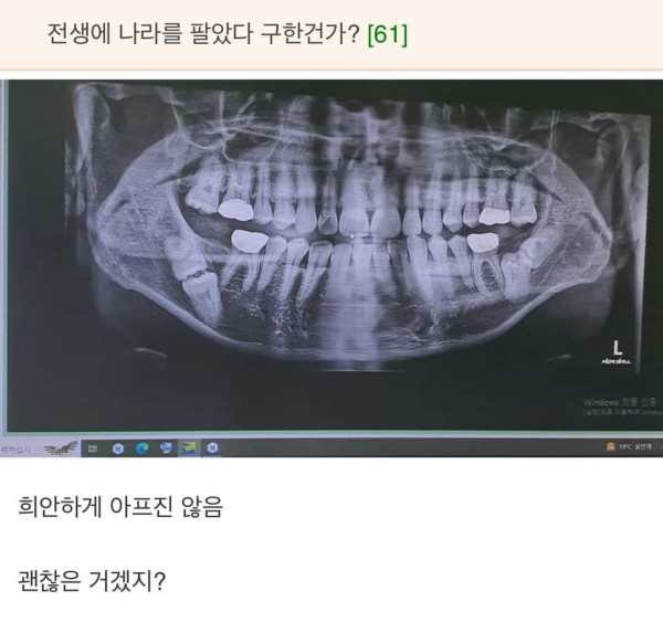 흔한 매복사랑니 상태